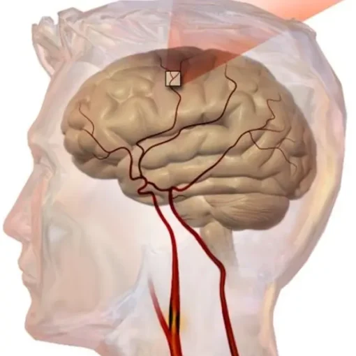 I fattori alla base del cambiamento di tendenza della cardiopatia ischemica e dell'ictus